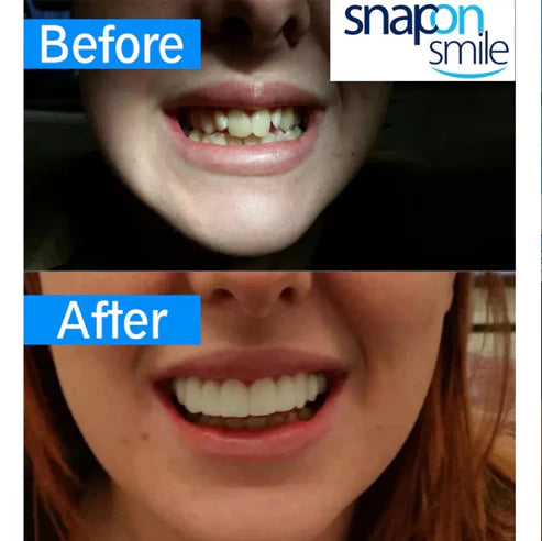 🦷 غطاء أسنان قابل للتركيب – ابتسامة طبيعية في ثوانٍ